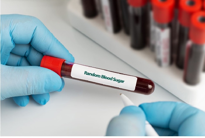 Random Blood Sugar