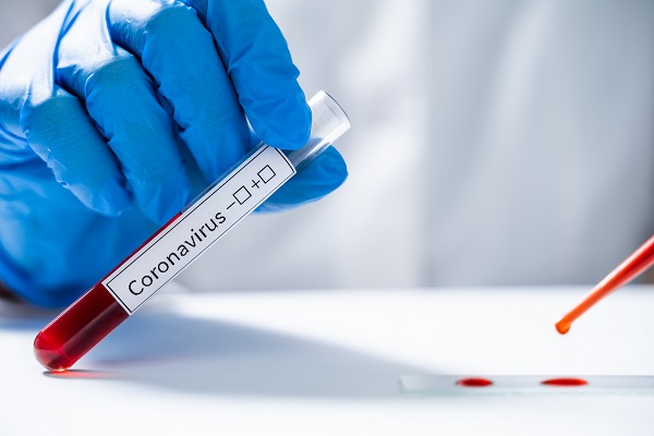 Covid Antibody IgG (Quantitative)